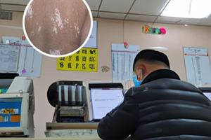 他克莫司軟膏屏障受損可以用嗎